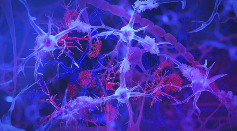 The illustration depicts microglia—the brain's immune cells—shown in light blue and purple, as they engage with red-colored amyloid plaques, protein accumulations associated with Alzheimer's disease. This visualization demonstrates how microglia serve as the brain's maintenance crew, monitoring neural health and removing cellular waste by Jason Drees/Arizona State University