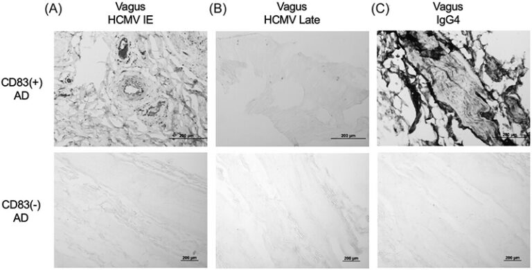 CD83(+) microglia. (A–B) HCMV and (B) IgG4 immunoreactivity in the vagus nerve of AD subjects with and without CD83(+) microglia. Representative photomicrographs shown. AD, Alzheimer's disease; HCMV, human cytomegalovirus; IgG4, immunoglobulin G4 by Dr. Ben Readhead, Medical Research, Arizona State University, USA